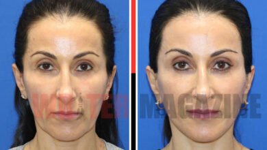 Botched Mini Face lift