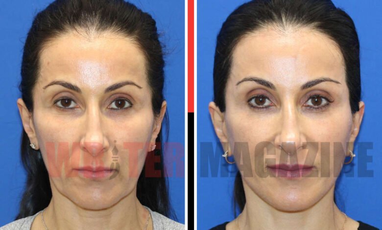 Botched Mini Face lift
