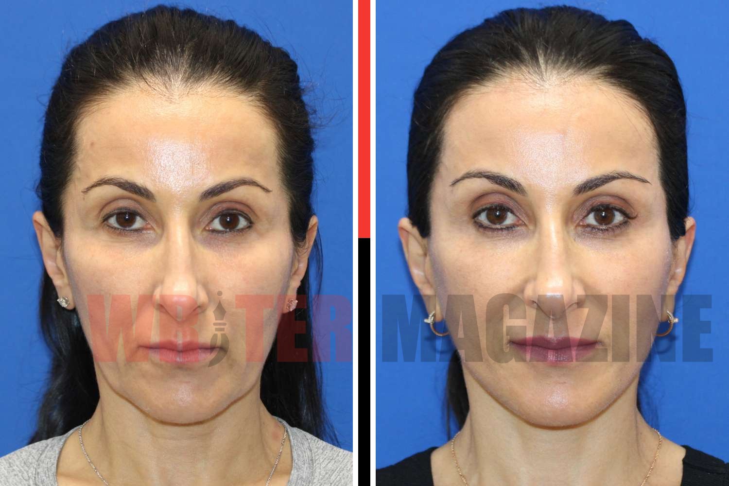 Botched Mini Face lift